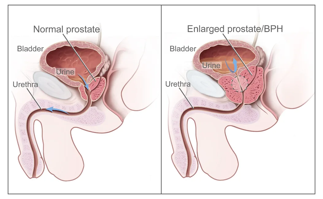 Two-panel National Cancer Institute drawing: normal male pelvic anatomy on the left and an enlarged prostate pressing on the urethra on the right.